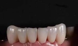 氧化锆全瓷 氧化锆全瓷
